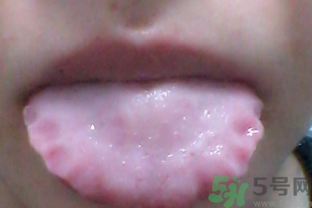舌頭上有齒痕怎么回事？舌頭上有齒痕怎么辦？