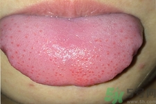 舌頭上有齒痕怎么回事？舌頭上有齒痕怎么辦？