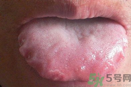舌頭上有齒痕怎么回事？舌頭上有齒痕怎么辦？