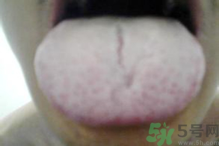 舌頭發(fā)白是什么原因？舌苔發(fā)白是怎么辦？