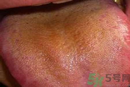 舌苔厚黃是怎么回事？舌頭發(fā)黃怎么辦？