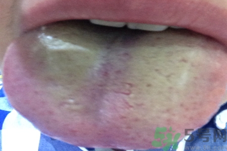 舌苔厚黃是怎么回事？舌頭發(fā)黃怎么辦？