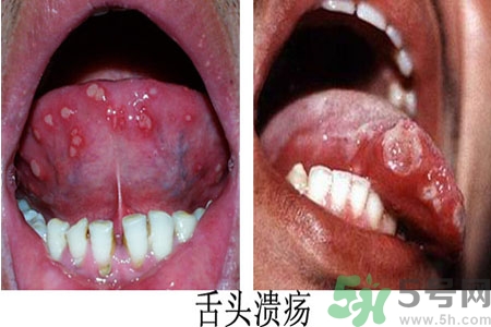 舌頭潰瘍怎么辦？舌頭潰瘍的原因？