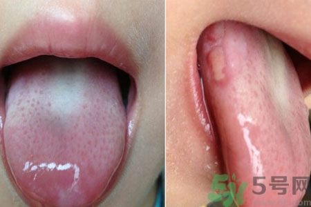 舌頭潰瘍怎么辦？舌頭潰瘍的原因？