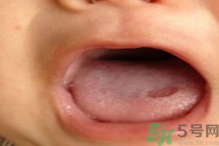 舌頭潰瘍怎么辦？舌頭潰瘍的原因？