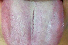 舌頭發(fā)白是什么原因？舌苔發(fā)白是怎么辦？