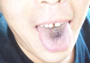 舌頭發(fā)黑怎么回事？舌頭發(fā)黑怎么辦？