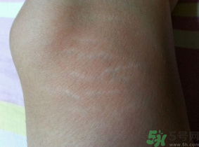 肥胖紋能去掉嗎？ 肥胖紋瘦了以后會(huì)消失嗎？