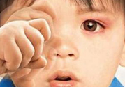 寶寶得了紅眼病怎么辦？寶寶得了紅眼病怎么治？