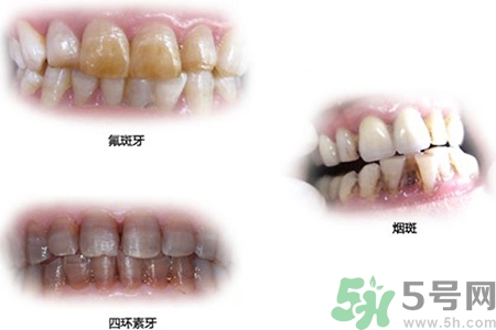 四環(huán)素牙是什么？四環(huán)素牙是怎么形成的？