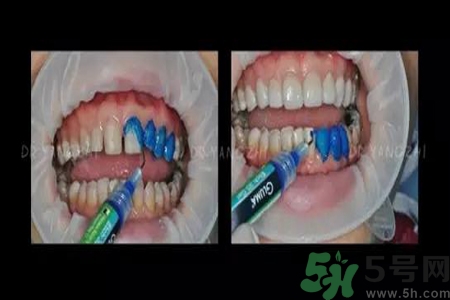 四環(huán)素牙是什么？四環(huán)素牙是怎么形成的？