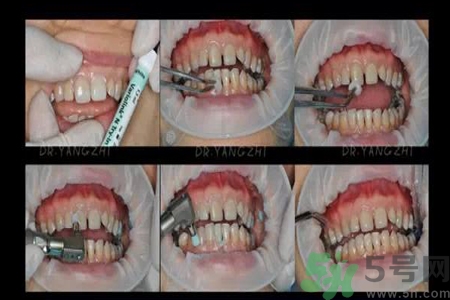 四環(huán)素牙是什么？四環(huán)素牙是怎么形成的？