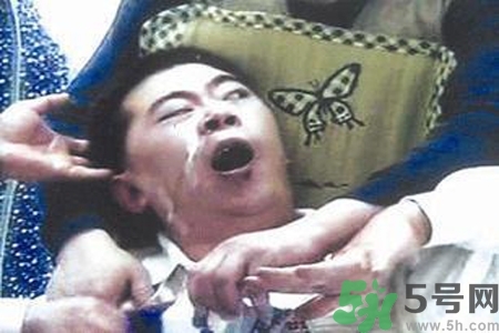 癲癇的典型癥狀有哪些？癲癇是什么？