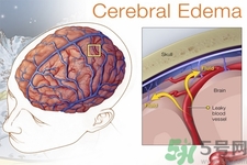 癲癇的發(fā)病因素？癲癇的并發(fā)癥有哪些？