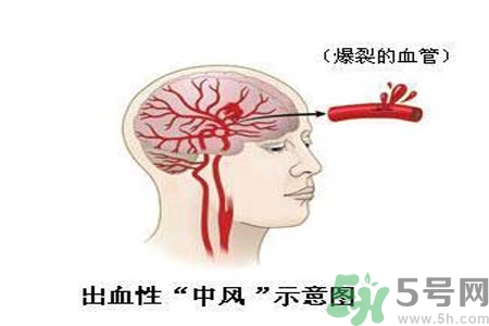腦中風的護理措施？腦中風的飲食護理？