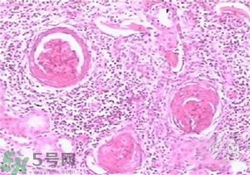 慢性腎炎能治好嗎？慢性腎炎能活多久？