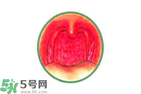 慢性咽炎的治療方法？慢性咽炎的藥物治療？