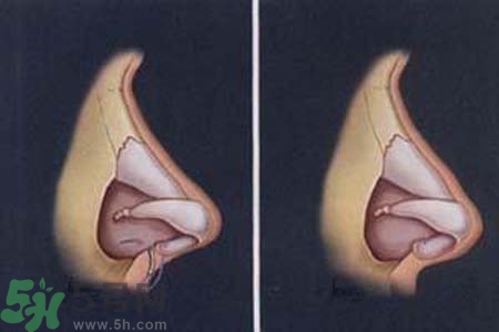 鼻竇炎的護(hù)理措施？鼻竇炎的飲食護(hù)理？