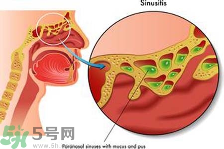 鼻竇炎的護(hù)理措施？鼻竇炎的飲食護(hù)理？