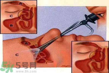 鼻竇炎的護(hù)理措施？鼻竇炎的飲食護(hù)理？