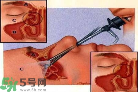 鼻竇炎的高發(fā)人群？如何預(yù)防鼻竇炎？