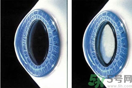 白內(nèi)障是什么？白內(nèi)障的癥狀有哪些？