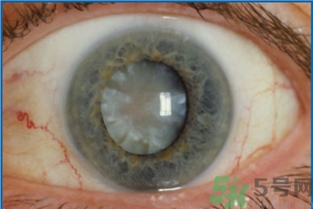 白內(nèi)障治療方法是什么？白內(nèi)障可以用什么藥物治療？