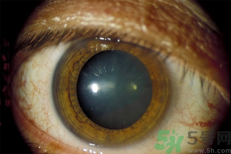 白內(nèi)障治療方法是什么？白內(nèi)障可以用什么藥物治療？