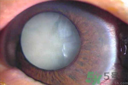 白內(nèi)障的高發(fā)人群有哪些？如何預(yù)防白內(nèi)障？