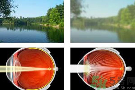 白內(nèi)障的高發(fā)人群有哪些？如何預(yù)防白內(nèi)障？