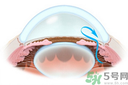 青光眼是什么？青光眼癥狀有什么？