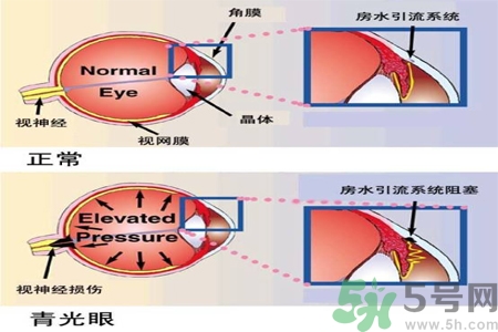 青光眼的護(hù)理措施有什么？青光眼的飲食護(hù)理有哪些？