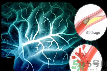 腦出血的發(fā)病因素是什么？腦出血的并發(fā)癥有哪些？