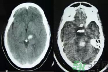 腦出血的發(fā)病因素是什么？腦出血的并發(fā)癥有哪些？