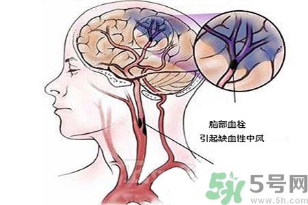 腦出血的治療方法是什么？腦出血可以用哪些藥物治療？