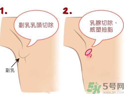 副乳是什么？副乳的危害