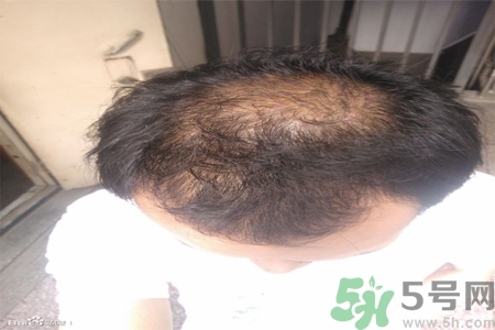 脫發(fā)的措施有什么？脫發(fā)的注意飲食有哪些？