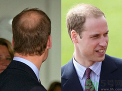 男人禿頂是什么原因？男人禿頂怎么辦？