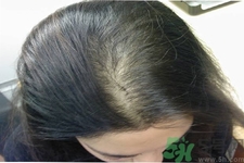 脫發(fā)的治療方法是什么？脫發(fā)的藥物治療有哪些？