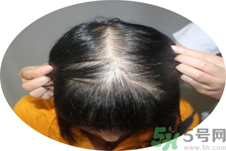 脫發(fā)的治療方法是什么？脫發(fā)的藥物治療有哪些？
