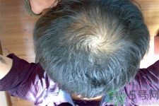 脫發(fā)的高發(fā)人群有哪些？如何預(yù)防脫發(fā)？