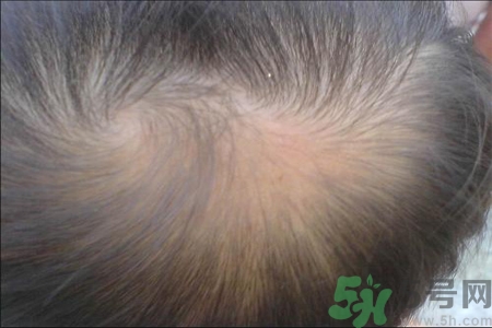 脫發(fā)的高發(fā)人群有哪些？如何預(yù)防脫發(fā)？