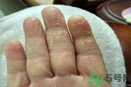 手足癬是什么？手足癬癥狀有什么？