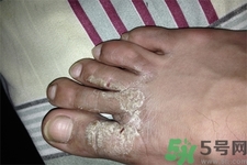 手足癬是什么？手足癬癥狀有什么？