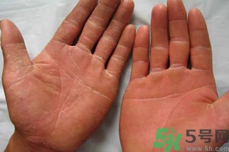 手足癬是什么？手足癬癥狀有什么？