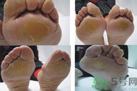 手足癬是什么？手足癬癥狀有什么？