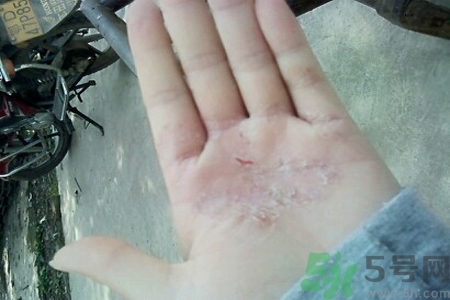 引起手足癬的主要原因？手足癬會引發(fā)什么疾病？