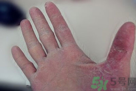 引起手足癬的主要原因？手足癬會引發(fā)什么疾??？