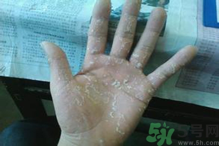 引起手足癬的主要原因？手足癬會引發(fā)什么疾?。?></p><h3>手足癬會引發(fā)什么疾病</h3><p>手足癬除了其臨床表現(xiàn)外，還可引起其他疾病。本病可引起丹毒、急性淋巴管炎和急性蜂窩組織炎，故應(yīng)引起臨床醫(yī)生和患者的高度重視。</p>		</div>
<div align=