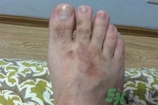 手足癬的治療方法？治療手足癬可以用什么藥？